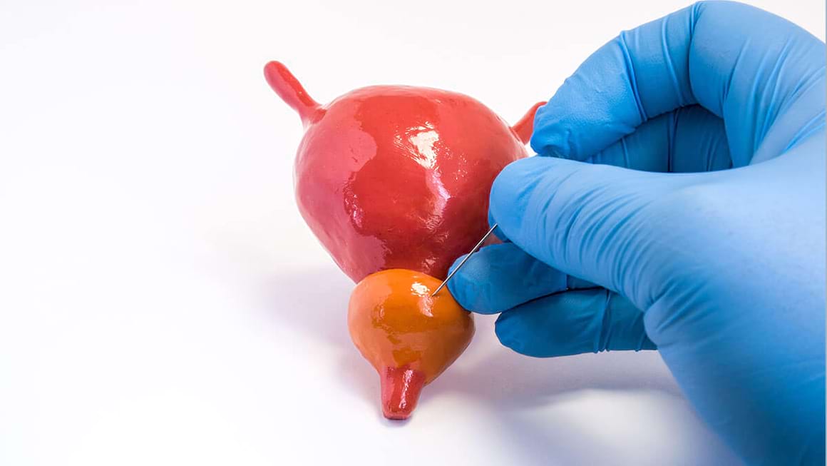 Adenomul de prostata (hiperplazia benigna de prostata sau prostata marita): Simptome, Cauze, Tratament - Doc.ro